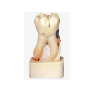 Dissected Model of Dental Disease